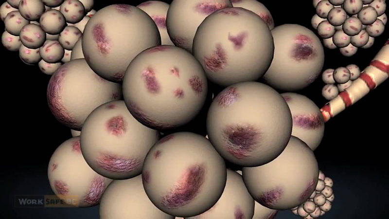 Degeneración de los pulmones por exposición a sílice.
